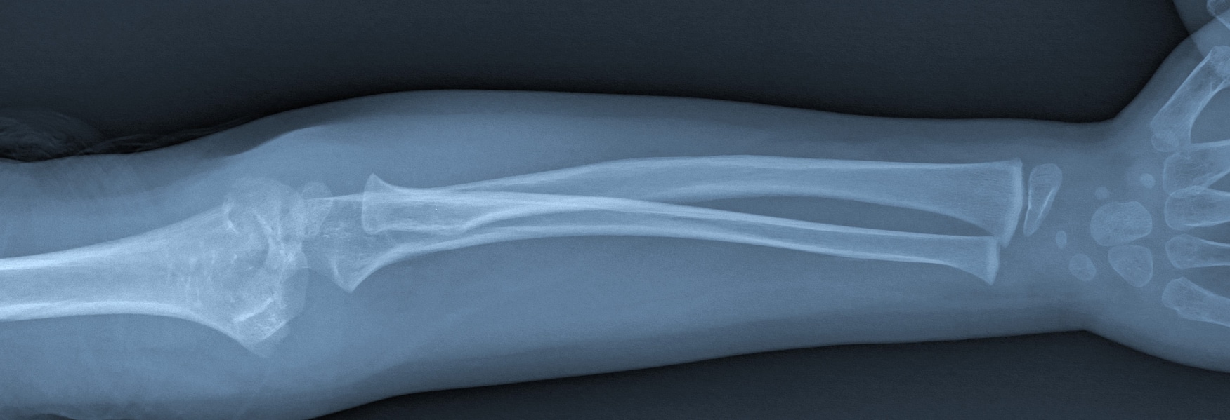 Broken arm xray